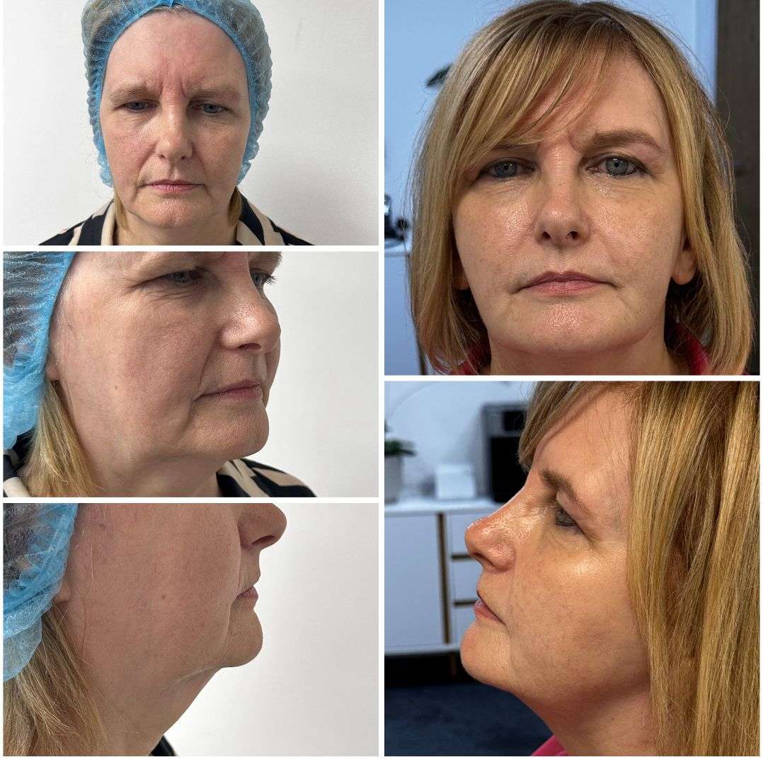 Endolift Treatment