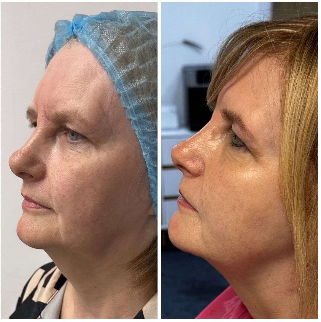 Endolift Treatment