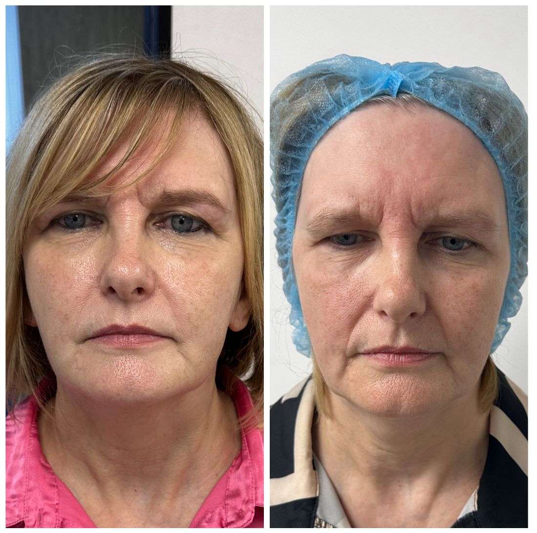 Endolift Treatment