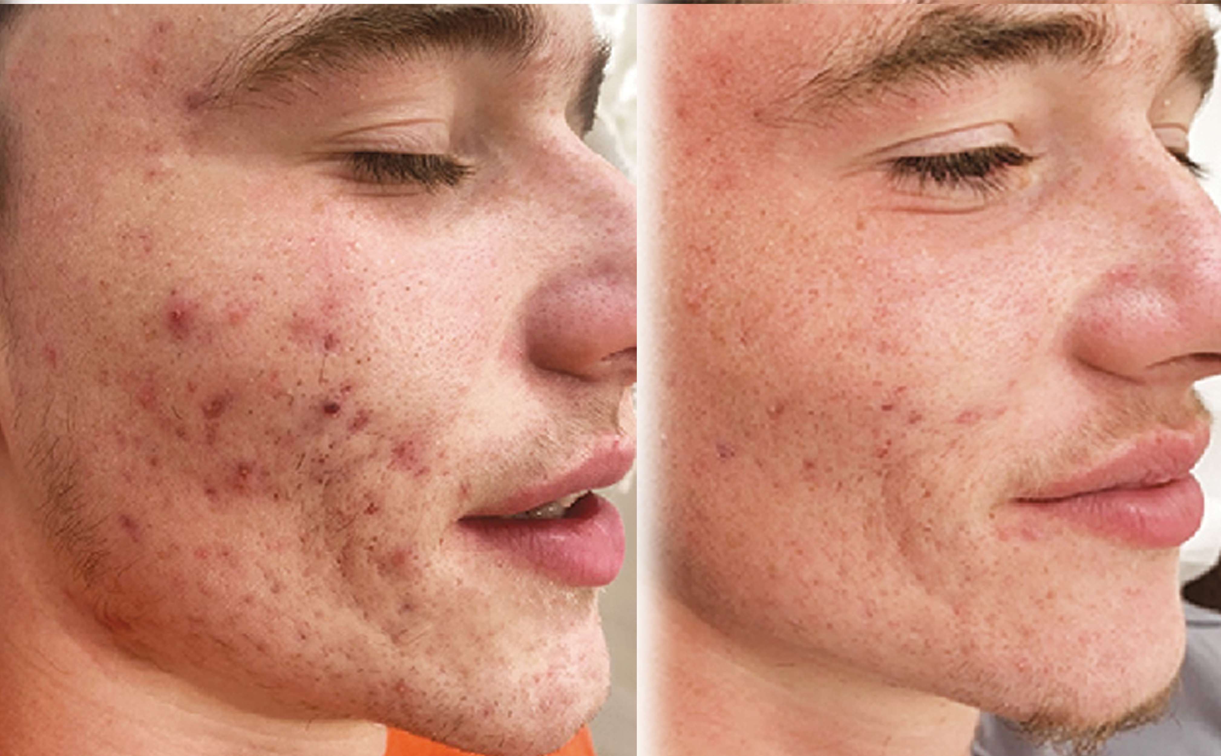 Skin Treatment