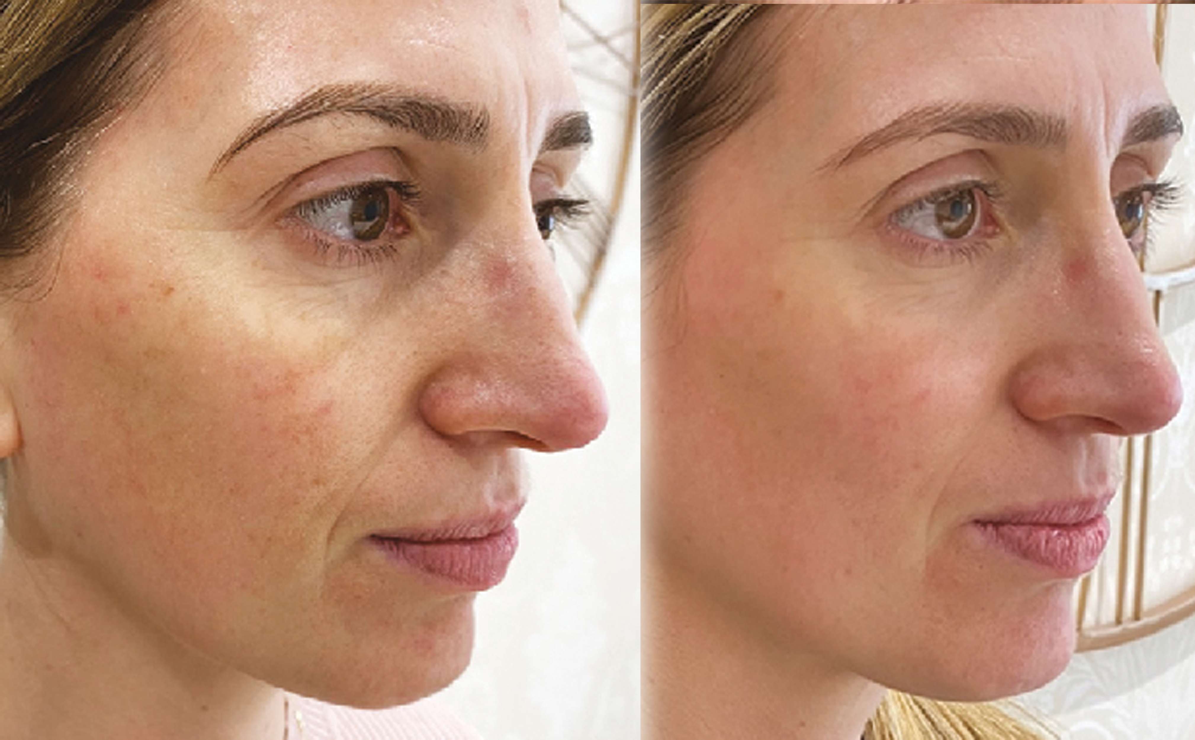 Skin Treatment