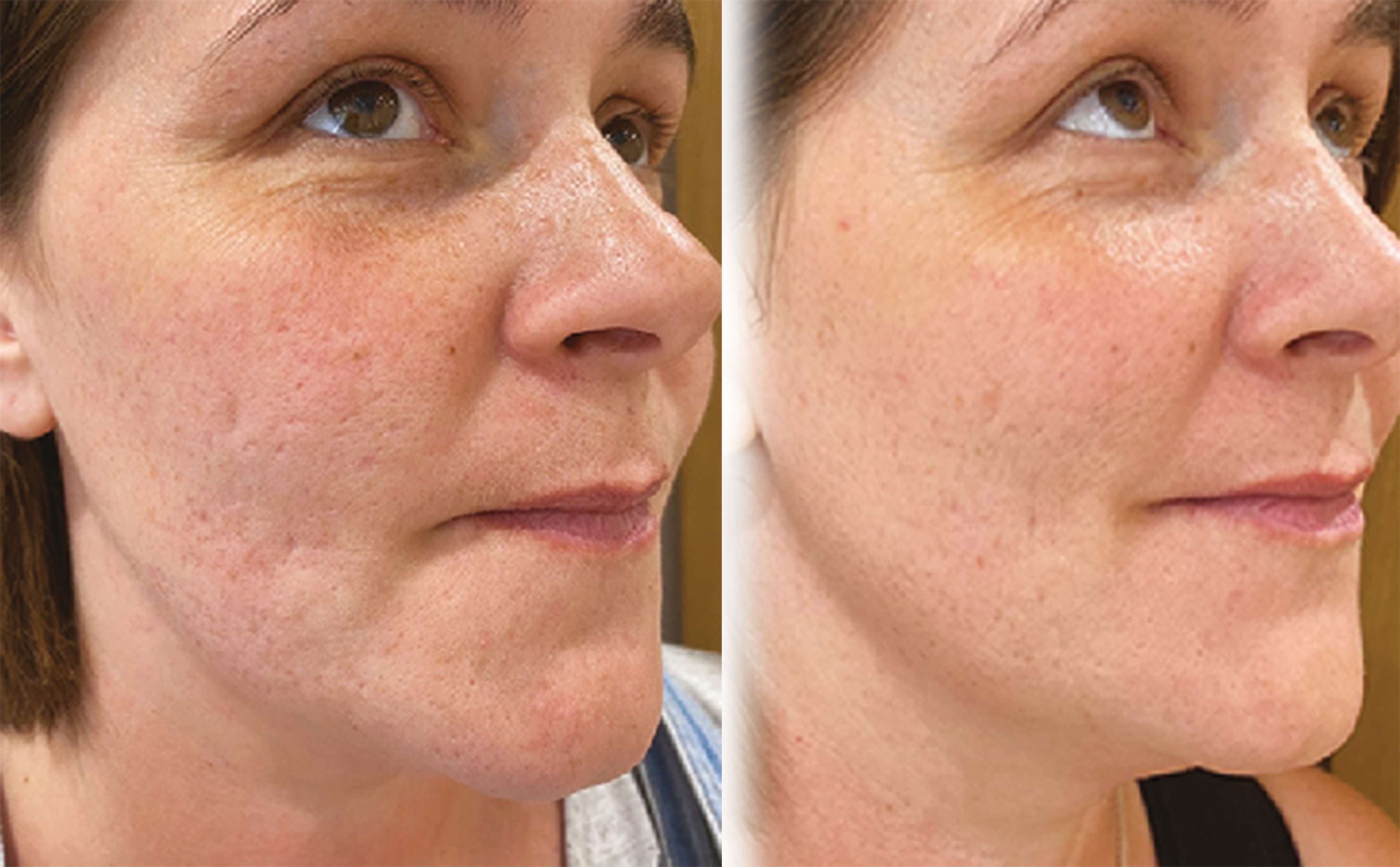 Skin Treatment