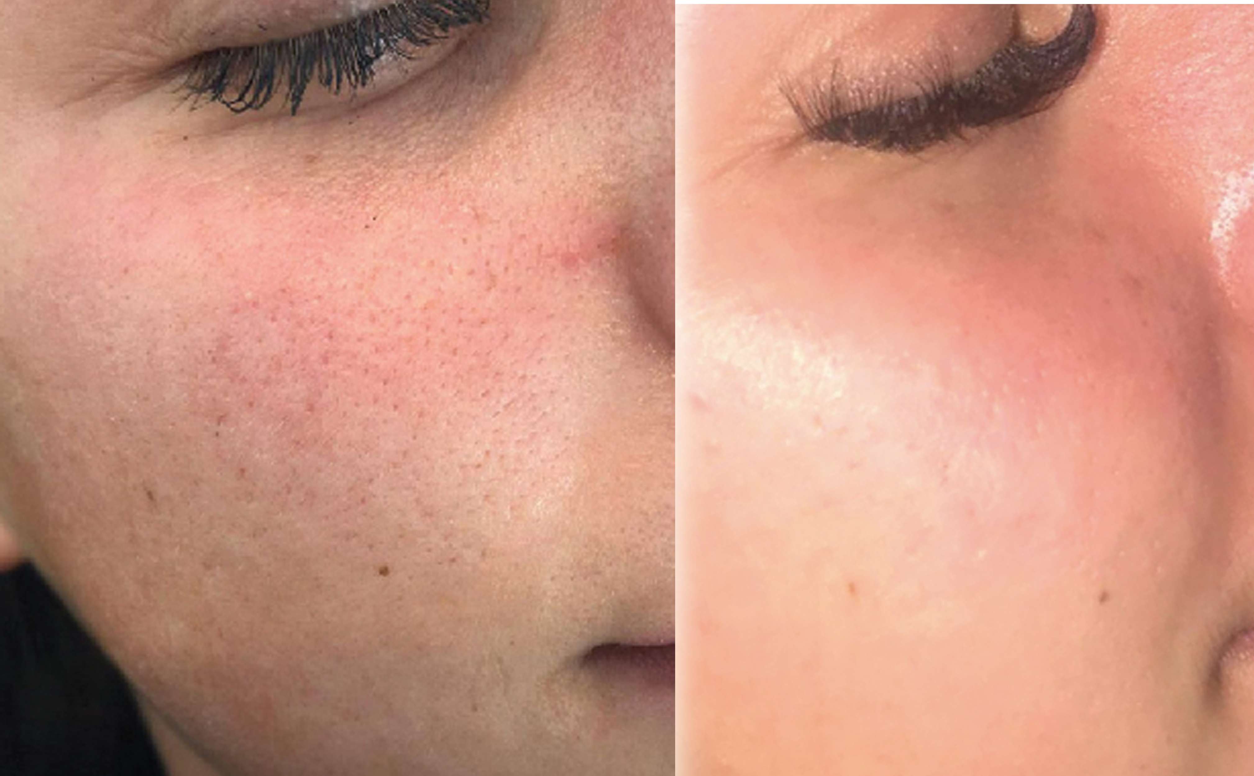 Skin Treatment