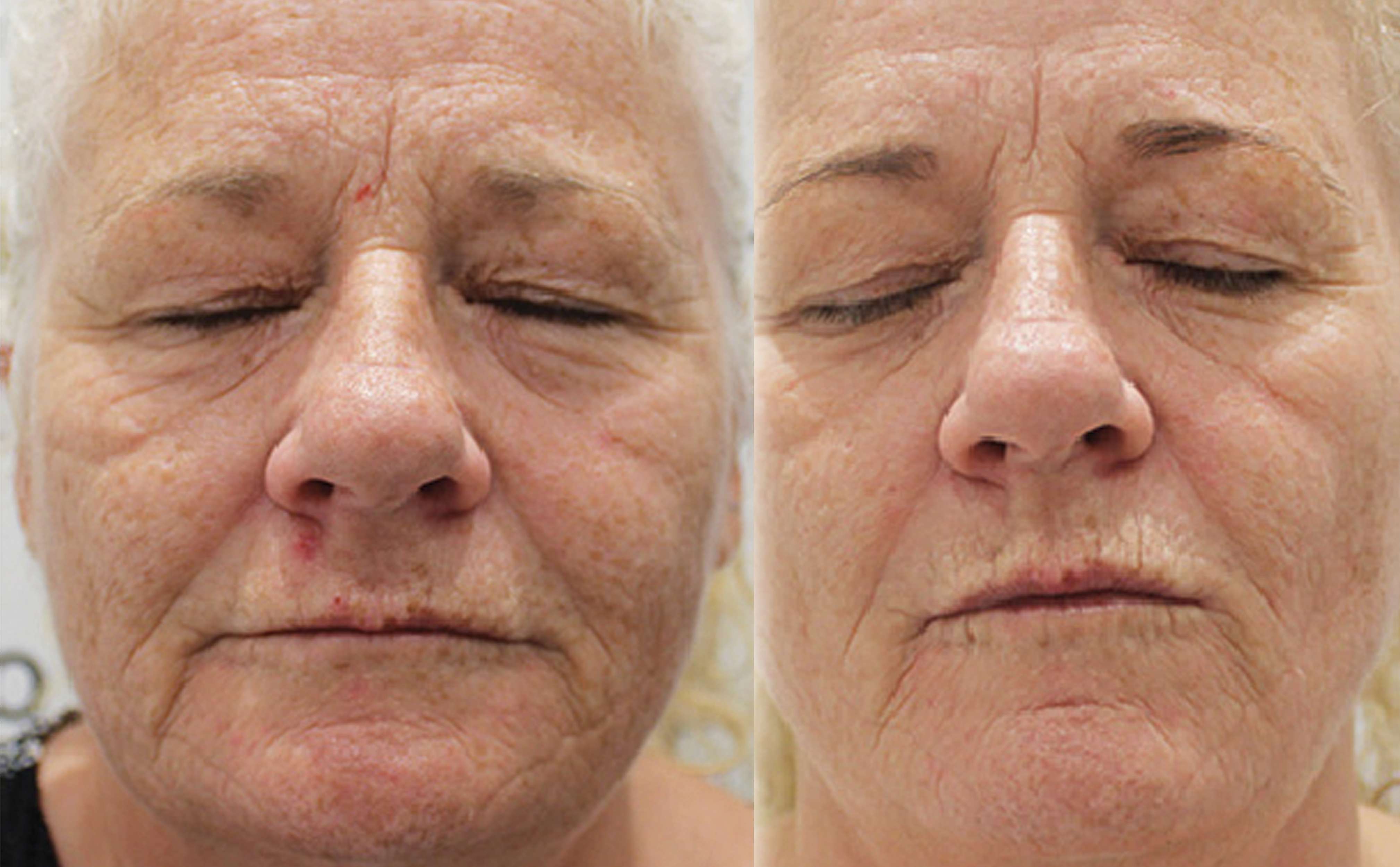 Skin Treatment