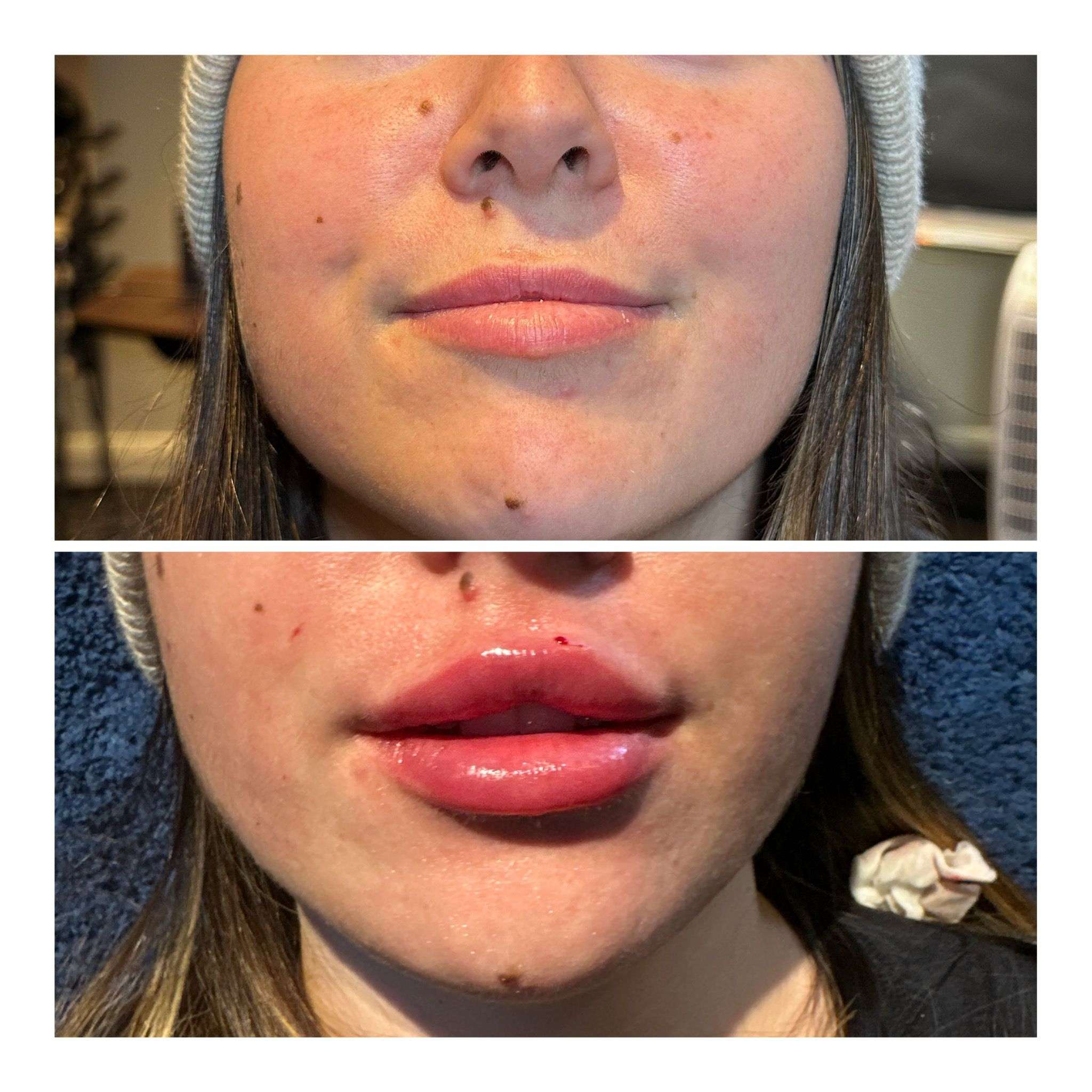 Acne Treatment