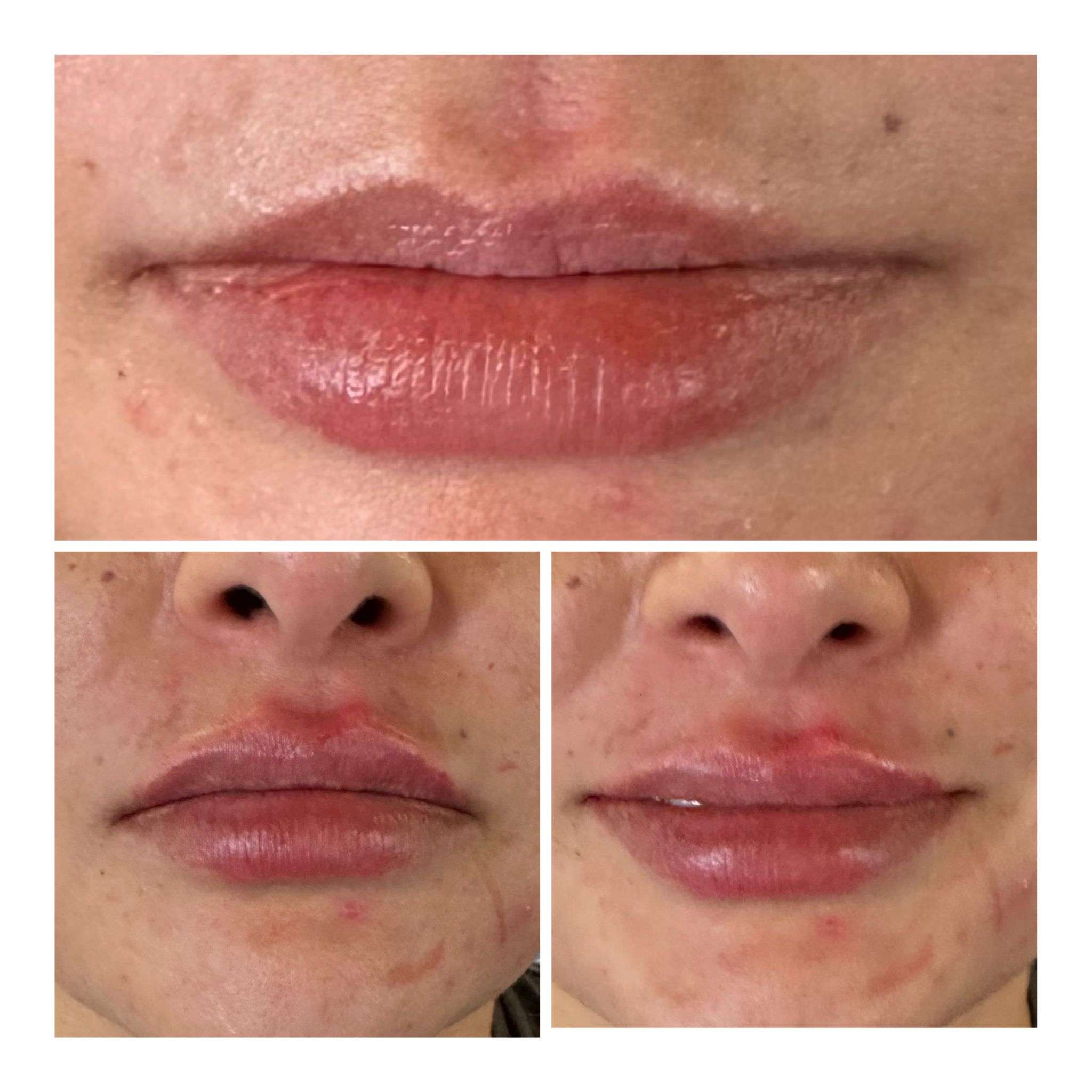 Laser Treatment