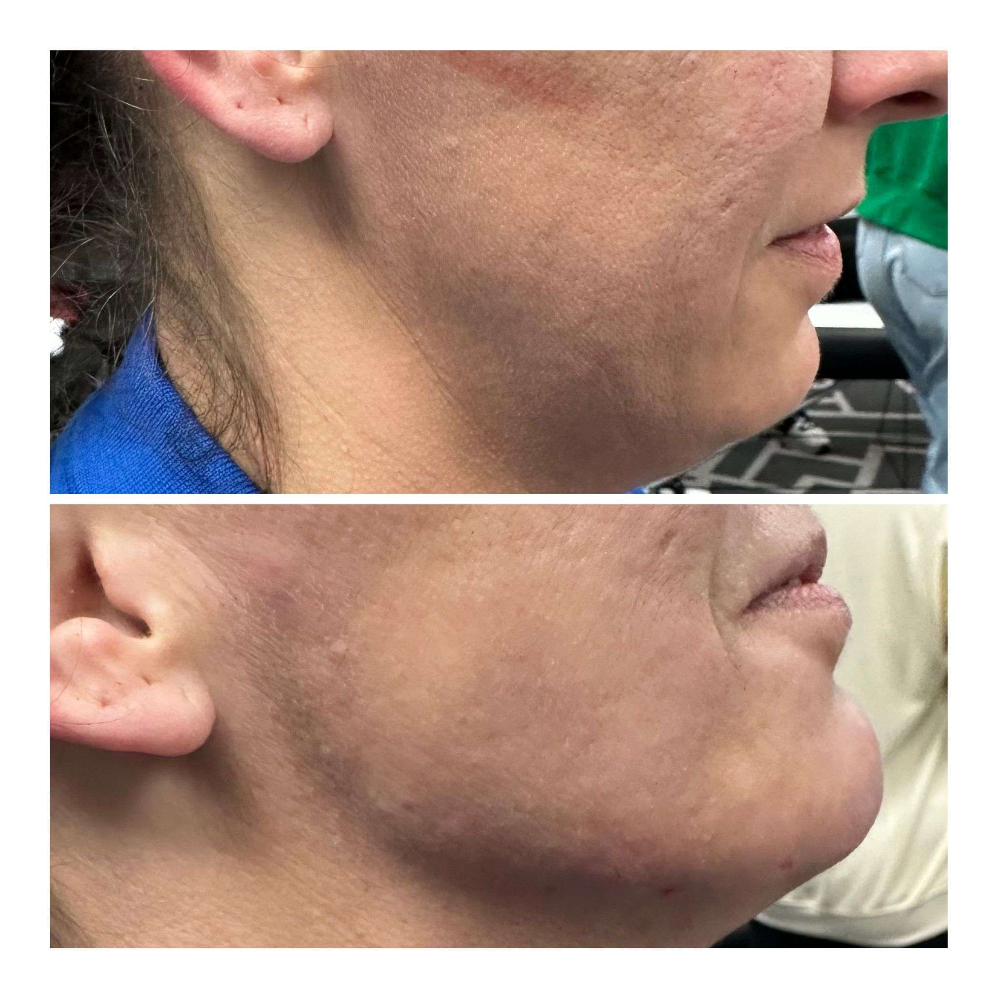 Skin Rejuvenation